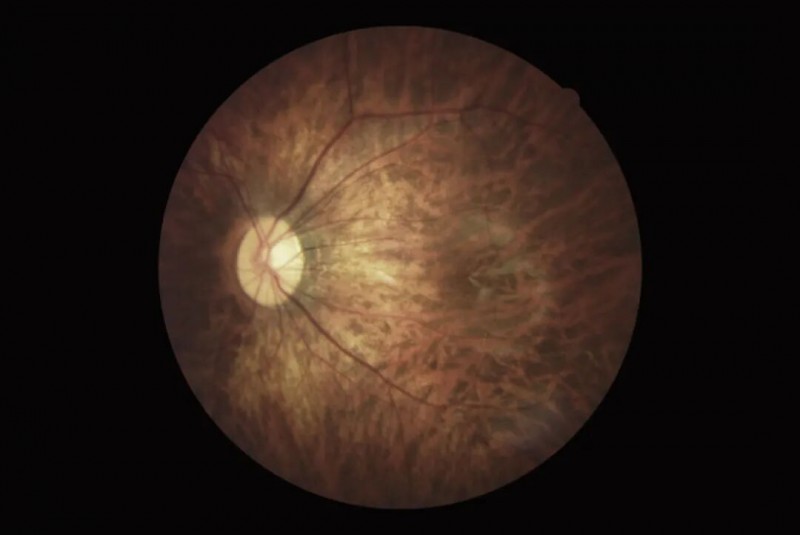 东南眼科医院开展春季学期近视防控科普直播